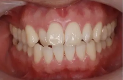 症例A 施術前写真その1