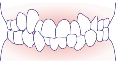 叢生（凸凹歯列） イメージ