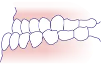 下顎前突（受け口） イメージ