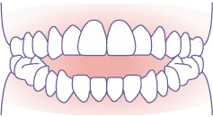 開咬（口が閉じない） イメージ