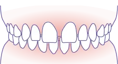 空隙歯列（すきっ歯） イメージ