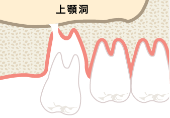 親知らずの抜歯 三軒茶屋マルオ歯科