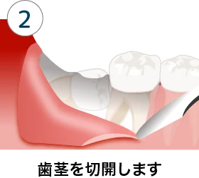 親知らずの抜歯 三軒茶屋マルオ歯科