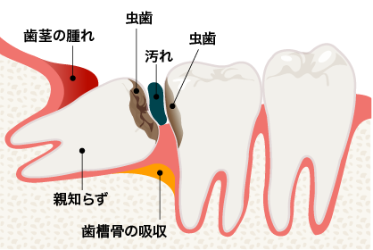 親知らずの抜歯 三軒茶屋マルオ歯科